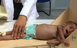 人間煉獄！葉門3年內戰  8.5萬孩童活活餓死