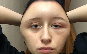 DIY染髮過敏  少女腫成「燈泡頭」險死