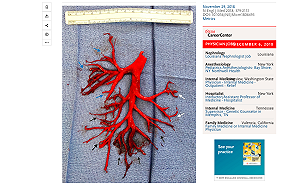 驚！36歲男子咳出完整「支氣管樹血塊」 一周後辭世