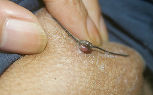 紅線綑綁息肉根部　大叔3天後掛急診