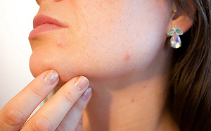 臉粗糙不平靠去角質改善？醫師：一種膚質的人比較有用