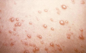 大人得水痘比小孩更嚴重！醫師：可能有「這些」併發症