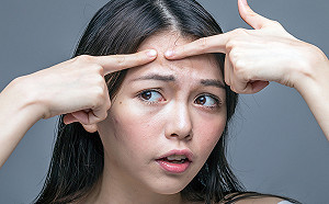 6成國人有青春痘困擾　中醫對症治療從體質改善