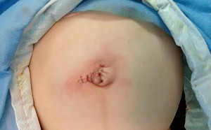 兒子肚臍「鼓鼓的」　父母竟拿刀片「放氣」害腸子流出