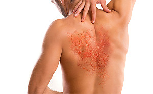 老翁皮蛇纏身難入眠　中醫內服外用擊退神經痛