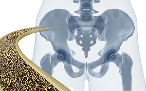 老年男性也有骨質疏鬆　但大多都不積極治療