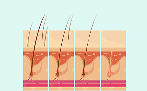 脂漏性毛囊炎掉髮　當心年節高熱量飲食復發