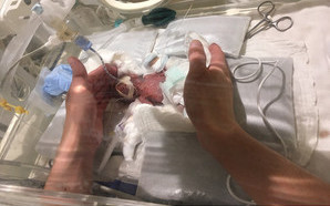 268克！全球最小男嬰健康出院  會自己喝母奶