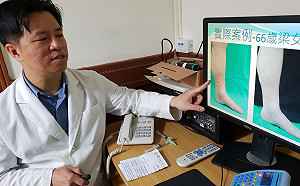靜脈曲張新療法　泡沬注射無需開刀療效佳