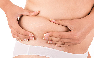 年後小腹婆激增  局部雕塑成熱搜關鍵字