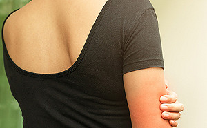 異位性皮膚炎誤用偏方下場　恐導致併發症難收拾