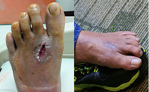 「腳掌被鐵釘刺穿」打破傷風後仍腫痛　發現染罕見細菌