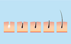 壓力大服用肌肉鬆弛劑　虛冷體質鬼剃頭機率高