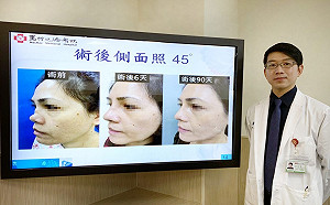 清粉刺弄到「細菌竄入吃掉鼻軟骨」 熟女鼻子塌陷天天哭