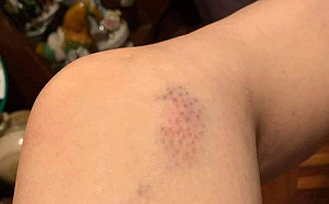 李進勇人事案多處掛彩  林奕華控訴民進黨暴力