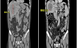 男患肝癌轉移「肺部佈滿數十顆腫瘤」　用對療法僅剩兩顆