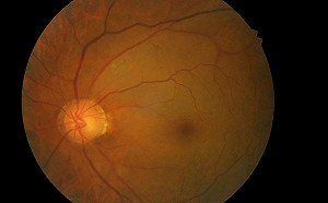 「眼中風」無痛　過了這時間恐喪失視力