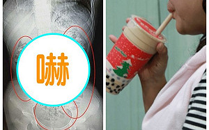 密集恐懼別看！14歲妹喝珍奶便秘　腸胃驚見「百顆陰影」