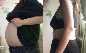 女子肚子大驚見藏16公斤水瘤　醫：腹胖合併三症狀要檢查