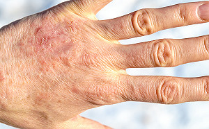 乾癬反覆發作好難纏　中醫內外調理多管齊下