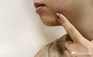 口服避孕藥可治痘痘？食藥署：勿誤信偏方！