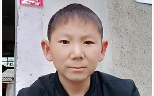 兒時遭石頭擊中頭部　34歲男子青春永駐