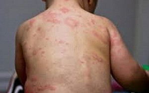 阿根廷爆麻疹疫情 3個月內病例劇增