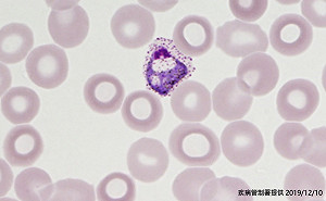 3年來首例！50歲女性境外染瘧疾回國又復發