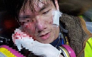 催淚彈攻擊眼部 浸大學生記者右顴骨中彈受傷