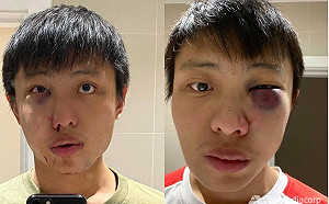 武漢肺炎》排華歧視  新加坡留學生倫敦街頭遭暴打