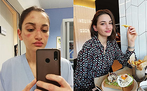 滿臉勒痕！義大利正妹護理師提「一請求」　90萬人心疼