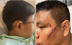 美國泰裔一家4口遭襲嚴重毀容 疑涉武漢肺炎種族歧視