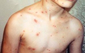 台師大學生染水痘  校方：已移隔離宿舍或返家