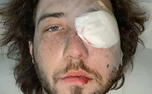 遭催淚彈擊中「被迫摘除眼球」  美示威者：我的眼睛只是小小代價