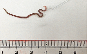 （影）她吃生魚片5天後 醫師在咽喉取出3.8公分活蠕蟲