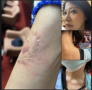 咬痕清晰可見！林楚茵提告呂玉玲強制及傷害罪 批民主法治惡劣示範