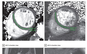 驚！美德研究：武肺病毒疑直攻心臟 康復也難倖免
