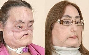 遭夫槍擊毀容  美國首名臉部移植者術後12年逝世