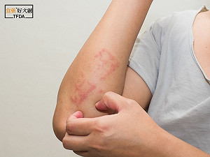 專科醫師帶路！三招對抗異位性皮膚炎