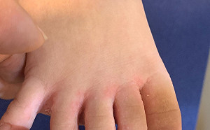 2歲童驚染香港腳！醫生：家中地板成黴菌播種地