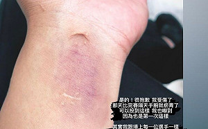 中職/王維中受傷手腕瘀青 放照片回應酸民