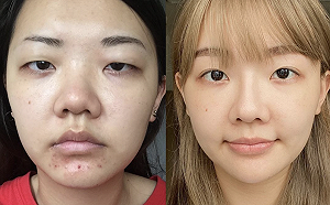 Youtuber「福爾思庭」整形前後大對比！粉絲驚：完全看不出來