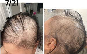 日女打莫德納掉光頭髮！日本還有3例打BNT掉髮