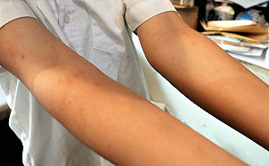 澎湖爆怪病！大批民眾皮膚奇癢紅腫就診 衛生局回應了