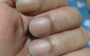 指甲浮現垂直凹痕！過來人勸快就醫