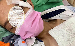 挖眼案翻版! 台中超商員勸戴口罩被打到眼窩破碎、血胸、肋骨斷6根