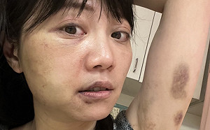 高嘉瑜被打照曝光 全身傷口「眼睛被揍、雙腿見血」