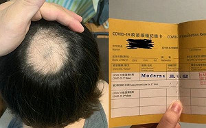 24歲女打完莫德納變「禿頭少女」 不敢接種第二劑:沒醫師願開診斷書