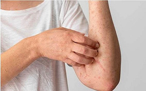 年菜、零食藏過敏原！小心慢性過敏