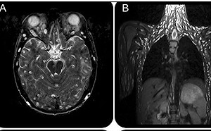 吃生豬肉抽蓄「感官扭曲」！男子就醫檢查驚見「全身長滿寄生蟲」